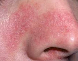 Покраснение и шелушение вокруг носа: какие факторы провоцируют симптом, и как от него избавиться?