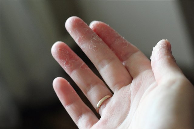 Почему шелушится кожа на пальцах рук: основные причины и способы лечения