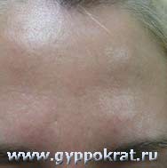 Лазерная редукция (сужение) пор