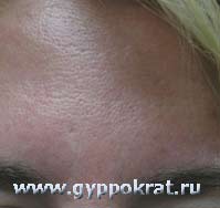 Лазерная редукция (сужение) пор